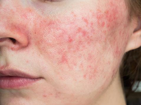 Acne em adultos